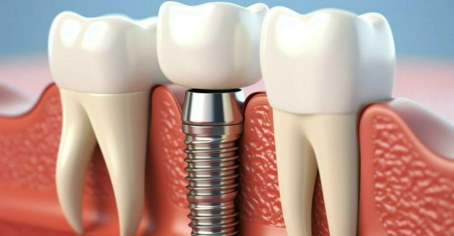 Dental Implants Safe